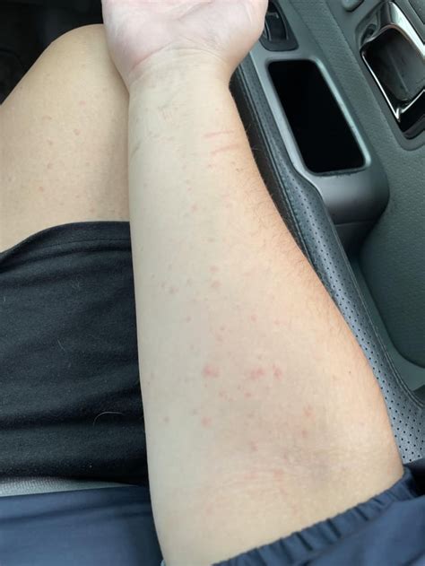 Lamotrigine rash? : r/Lamotrigine