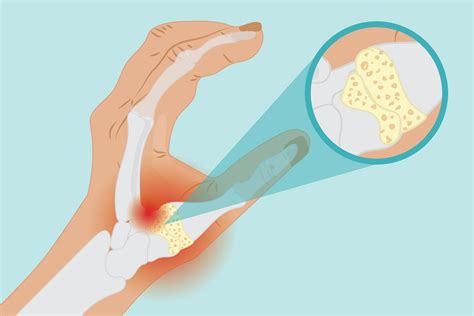 Basal Joint Arthritis Pictures