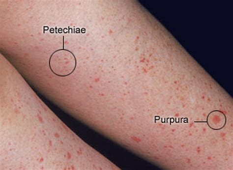 Petechiae - Symphtoms of hemorhagic spots | hubpages