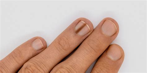 What is Nail Melanoma? | NUHS