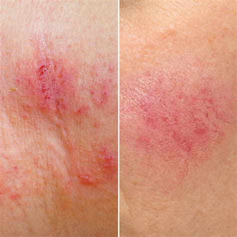 Eczema vs. Rosacea: Key Differences, Symptoms, and Treatments – SLMD Skincare by Sandra Lee, M.D ...