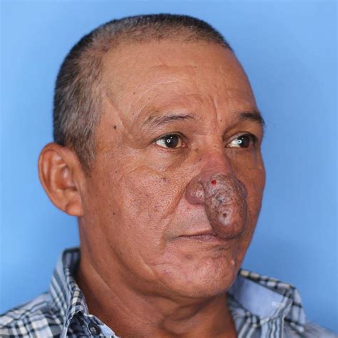 Man with deformed nose gets life-changing surgery - NZ Herald