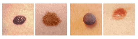 Skin Cancer Moles Early Stages - 10 Signs of Skin Cancer