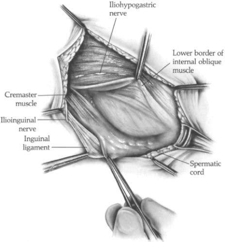 Iliopubic Tract Repair of Inguinal Hernia: the Anterior (Inguinal Canal) Approach | Basicmedical Key