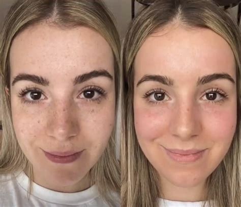 Cosmelan vs Dermamelan Depigmenting Peel — Erin Aesthetics