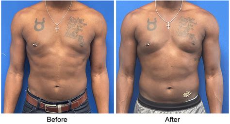 Gynecomastia Before & After Photos Louisville, KY - Abdominoplasty