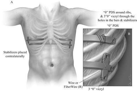 The Minimally Invasive Repair of Pectus Excavatum - Operative Techniques in Thoracic and ...