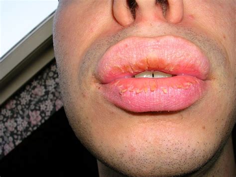 Exfoliative cheilitis after 12 years On CureZone Image Gallery