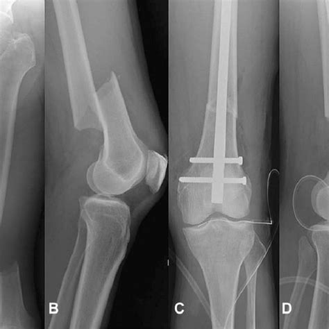 (A) and (B) Radiographs of the fractured distal femur showing a ...