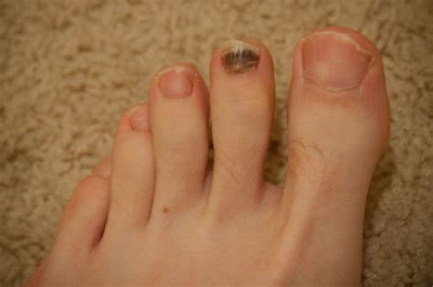 melanoma of toenail - pictures, photos