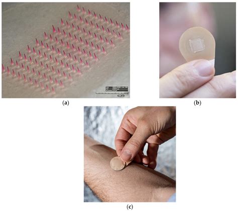 Vaccines | Free Full-Text | Dissolvable Microneedle Patches to Enable Increased Access to ...