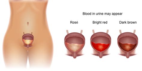 Red Urine