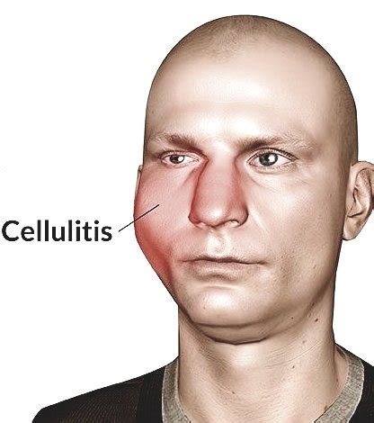 Cellulitis symptoms nose: The request could not be satisfied