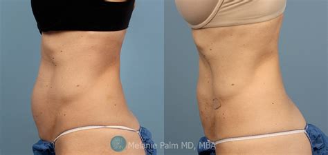 Laser Liposuction with Accusculpt Before and After Photos