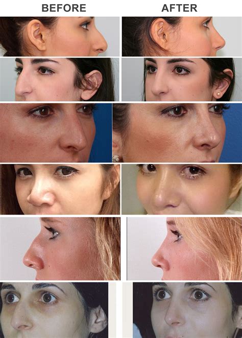 Best cost of Rhinoplasty in Delhi|Nose Surgery in Delhi by Best Cosmetic Surgeon