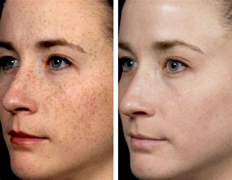 Laser To Remove Dark Spots On Face