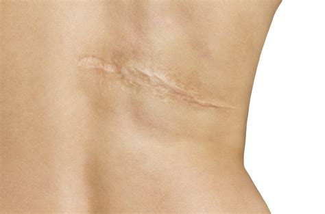 Scar Removal Treatment | U.S. Dermatology Partners