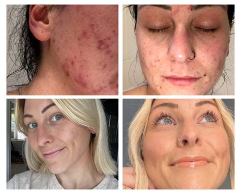 Skin + Me Stories: Before and After Acne with Jessica Holt – The Dose