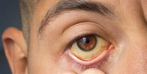 What Causes Yellow Eyes or Jaundice Eyes? Know All About This Eye Condition | OnlyMyHealth