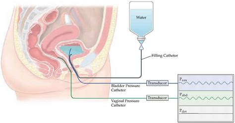 Urodynamics procedure or urodynamic testing, urodynamics test side effects