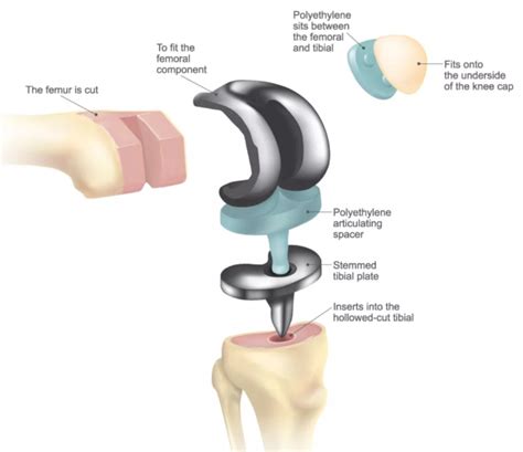 Patient's Guide to Total Knee Replacement - ATX Orthopedics