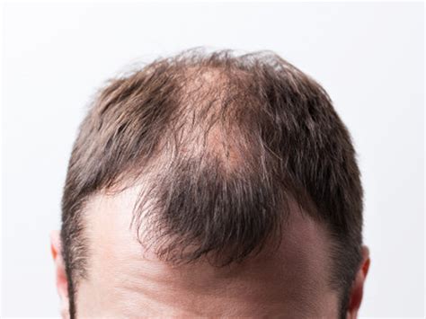 Alopecia Areata Diffuse Hair Loss