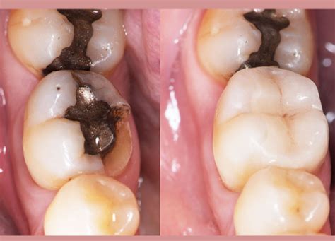 Black Stains on Teeth: Causes, Remedies and Treatment