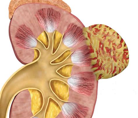 Angiomiolipoma: Entenda Causas, Sintomas e Tratamentos