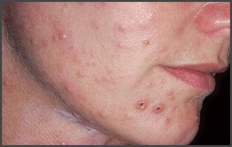 Shingles pictures face | Shingles Expert