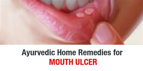 10 Home Remedies for Mouth Ulcer Relief - Dr. Brahmanand Nayak