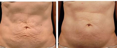 Before and after tummy with Thermage NY reduction. | Thermage ...