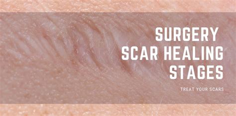 Surgery Scar Healing Stages - Treat Your Scars