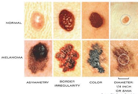 Abcde Melanoma Maligna Malignant Melanoma Stages High - vrogue.co