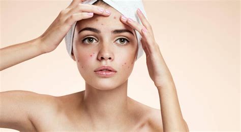 Acne Treatments for Sensitive Skin: Everything You Need To Know