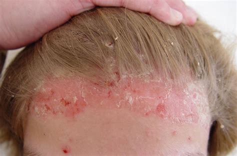 Pictures of psoriasis on face | Symptoms and pictures