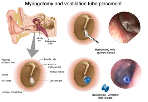 Ear Tube Surgery