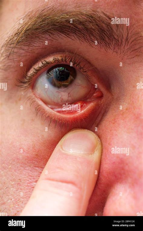 Stye Inside Eyelid