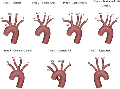 Aortic Arch Anatomy Variants