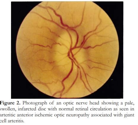 Ischaemic Optic Neuropathy in Southeast Asia A different pattern of disease – Philippine Journal ...