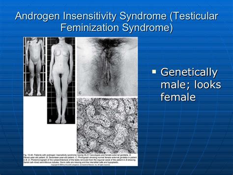 Androgen Insensitivity Syndrome (Testicular Feminization