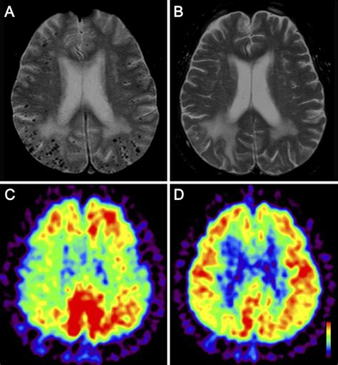 Figure1.MRI and PET scans of Case 1. A: Brain MRI showed cortical and ...