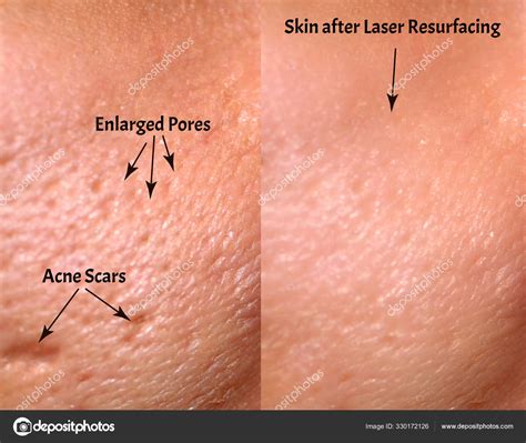 Large Pores Before And After