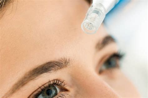 Understanding Micro needling Benefits for Skin and Beyond