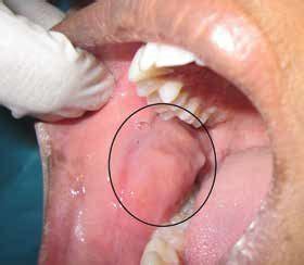 Oral Cancer Buccal Mucosa