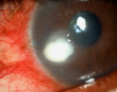 Fungal Corneal Ulcer