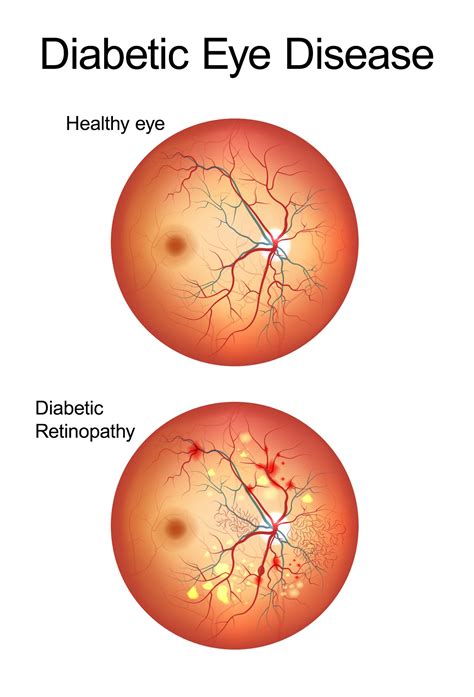 Diabetic Retinopathy Stages