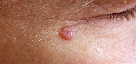 Basal Cell Carcinoma | Dermatology and Skin Health - Dr. Mendese