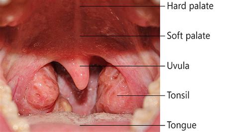 Uvula Cancer