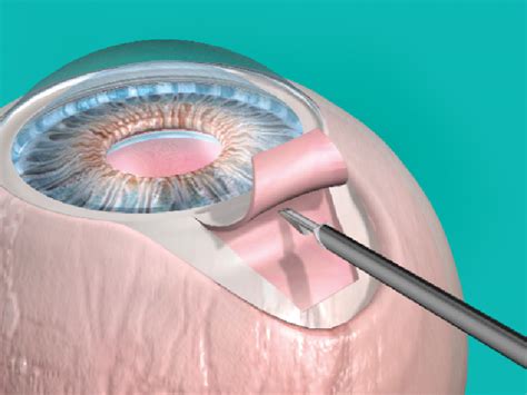 Glaucoma Surgery Procedure - Trabeculectomy and Sclerectomy - Eye ...