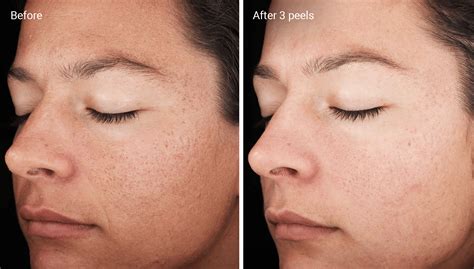 Chemical Peels for Acne Scars: Efficacy, Before and Afters, At-Home Uses (2023)